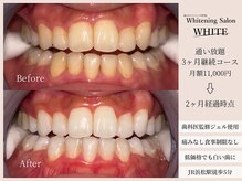 ホワイト(WHITE)/通い放題3ヶ月継続コース★WHITE