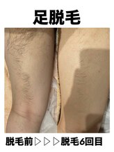 サロンエヌ 久留米店(Salon N)/男性の足脱毛★