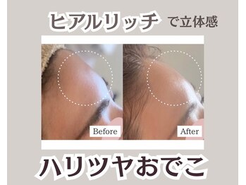 スリーメイ(3mey)/ヒアルリッチ導入で丸いおでこ