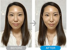 ワト(WATO)/■小顔施術（before→after)