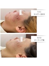エアリアル 大牟田店/ニキビにお悩みの方
