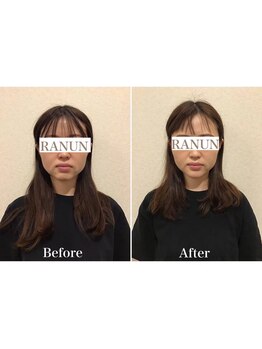 池袋東口整体院/むくみケア×小顔矯正