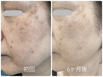 ベルネ(BELLUNE)/ベルネ式シミ改善