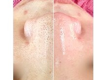 エレナ(ERENA)の雰囲気（頑固な鼻の角栓も一度で除去！クリアな素肌に★毛穴洗浄）