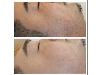 ビーカーブス 三鷹(B.curves)/男性　before・after