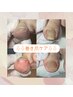 すぐに痛みが和らぐ◎巻き爪補正2箇所（指1本の両側） +オイルケア7,700円～