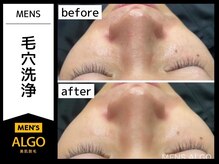 アルゴ 福井店(ALGO)/メンズ毛穴洗浄