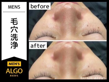 アルゴ 福井店(ALGO)/メンズ毛穴洗浄