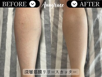 アングレイス(Anngrace)/【リリースカッター】BforeAfter