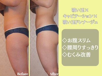 エステティックサロンティエリー/吸い玉×キャビ×ドレナージュ