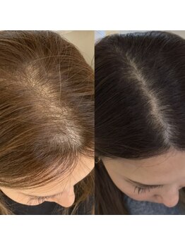 ラヴィ(Ravi)/プロセルヘッド