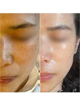 オリエンタルビューティー(ORIENTAL BEAUTY)/光フェイシャル×プラズマ