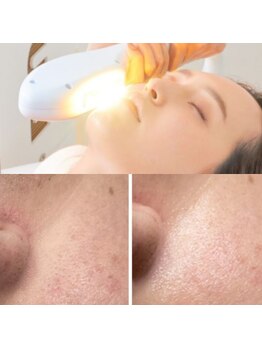 キワミ サーティスリー(kiwami33)/老人性色素斑との相性良いです