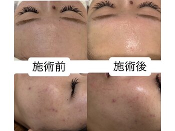 悠の写真/《美肌効果で自分の肌に自信が持てる!》肌のトーンアップや化粧ノリが格段にUP☆毛穴の黒ずみも改善◎