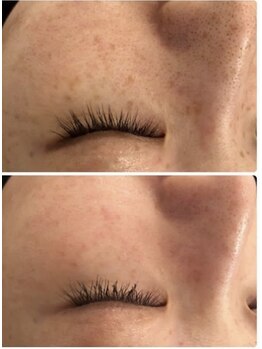 プランス 福岡(PLANCE)/シミケア　福岡天神　エステ