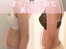 美人バスト 横浜店/バストアップ症例/育乳(6回施術)