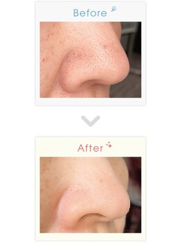 レリア(Reria)/毛穴洗浄