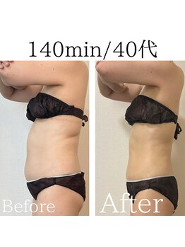 米香(MAIKA)/140分(小顔op)/40代/12回/-9キロ