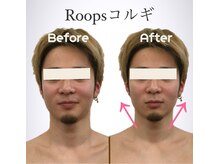 ループス(Roops)/ビフォーアフター【コルギ】