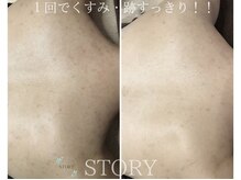 ストーリー 岐阜店(STORY)/ハーブピーリング専門店STORY