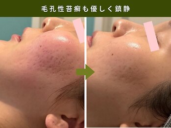 アンテサロン 関内店(Antesalon)/ハーブピーリングBefore&After