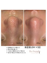 リサプリ(Re: Supple)/黒ずみ・赤み・ざらつきに