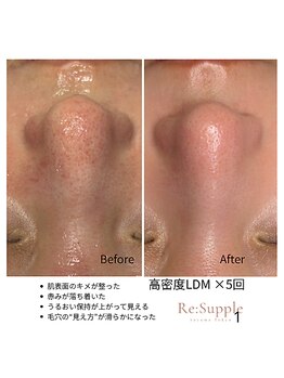 リサプリ(Re: Supple)/黒ずみ・赤み・ざらつきに