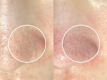 エモーショナル 姫路(Emotional)/毛穴エクストラクシション