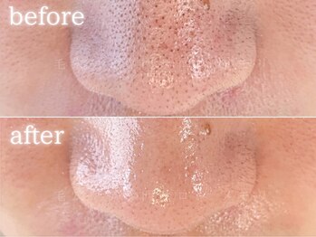 メモリ/お客様の変化/毛穴ケア