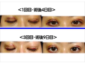 魔女のきもち/インディバで術後ケア