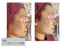 ベルティーク(beltheQue)の雰囲気（REVIハーブピーリング★体験コース1回BeforeAfter）