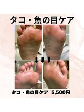 巻き爪補正店 徳重店/タコ・魚の目ケア