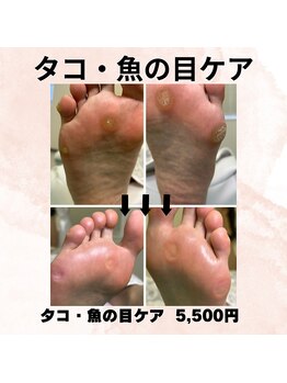 巻き爪補正店 徳重店/タコ・魚の目ケア