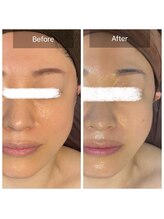 ラビ(RABBI)/40代女性小顔矯正