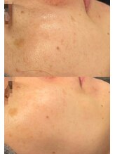 モルセラ(Moluccella)/9回の施術