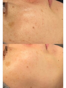 モルセラ(Moluccella)/9回の施術