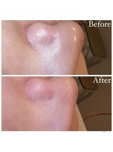 マドモアゼル 麻布十番/毛穴洗浄