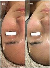 アミィ(amii)/肌育ボンバーフェイシャル