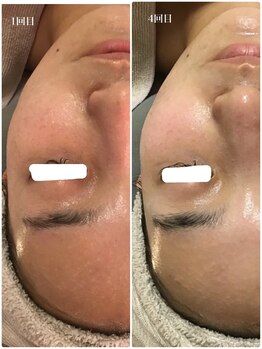 アミィ(amii)/肌育ボンバーフェイシャル