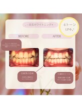 プラスビー 2号店(+b)/ホワイトニングビフォーアフター