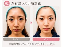 モアフェイス 池袋店(More Face)/小顔矯正　左右差　リフトアップ