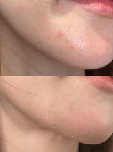 ハーシークレット(Her secret)/ブレンドハーブピーリング・DT中