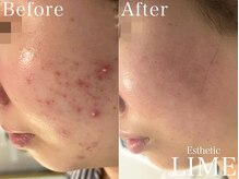 ライム 天神(LIME)/before&after　頬のニキビケア