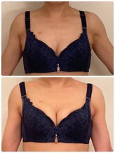 美人バスト 町田店/バストアップ◇症例◇