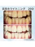 【8月限定 初回体験】美容ホワイトニング20分〈¥2980→¥1980〉