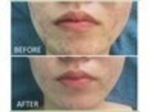 リフレーテ 道玄坂店/ハーブピーリング