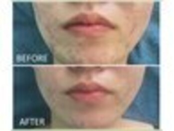 リフレーテ 道玄坂店/ハーブピーリング