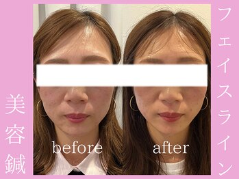 ビープラス(BEE PLUS)/フェイスライン、エラ