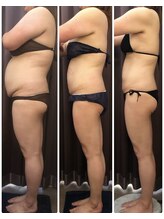 エステサロン ベリシモ(Bellissimo)/痩身/ビフォーアフター