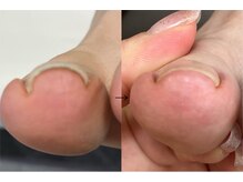 ロンディネ(Rondine)/巻き爪&トラブルネイルケア16